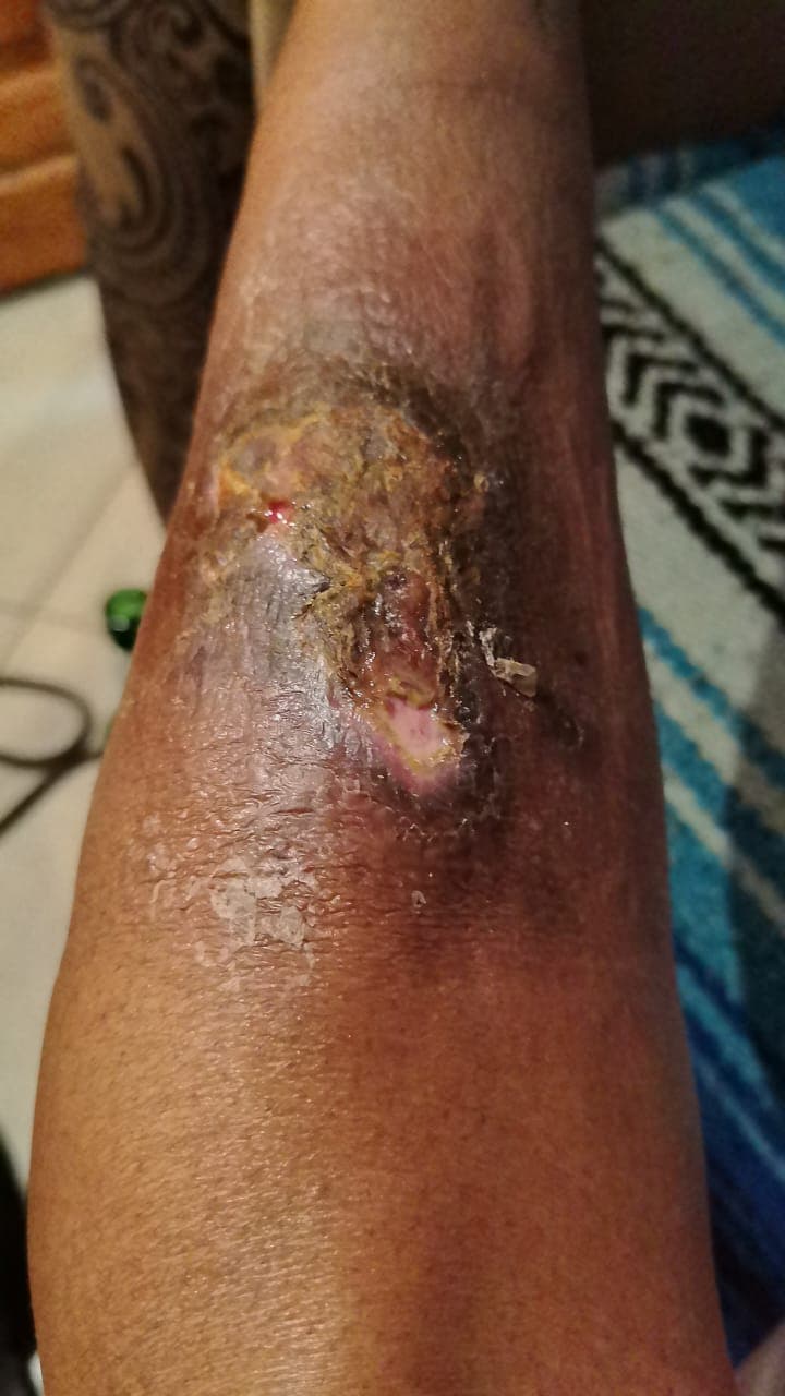 The burn wound during the process of healing